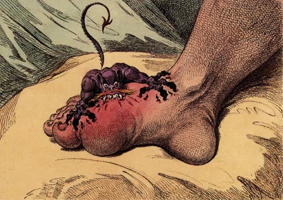 James Gillray's The Gout (1799) James Gillray's The Gout (1799)