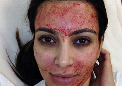 Kim Kardashian undergoes the Vampire facial. Image courtesy: Instagram