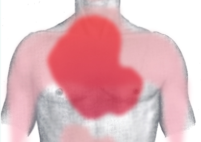 Rough diagram of pain zones in myocardial infarction; dark red: most typical area, light red: other possible areas; view of the chest