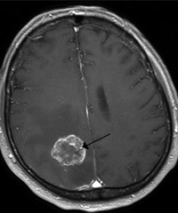 Brain metastasis in the right cerebral hemisphere from lung cancer shown on T1-weighted magnetic resonance imaging with intravenous contrast.