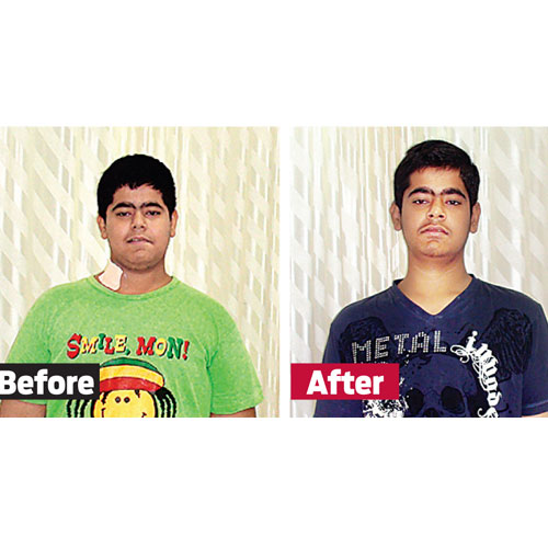 Laksh Motwani weighed 114kg before weight-loss surgery