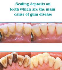 Scaling teeth