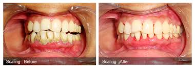 Teeth scaling meaning