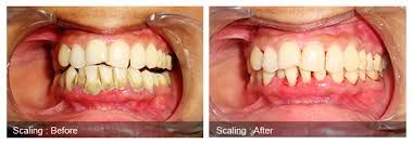 denture cleaner that remove stains and calculus buildup