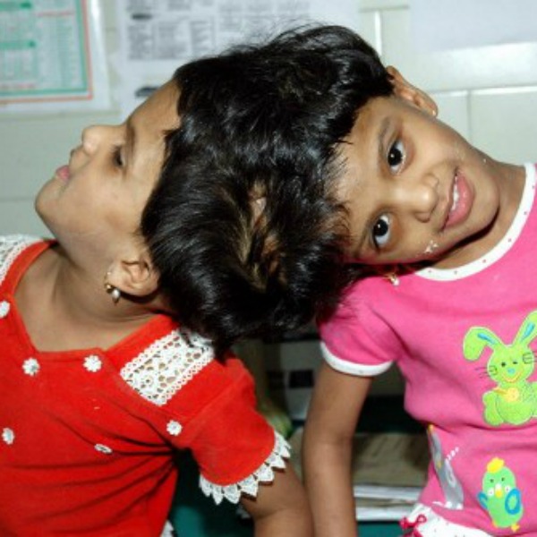 Conjoined twins Veena and Vani get fresh hope of separation.