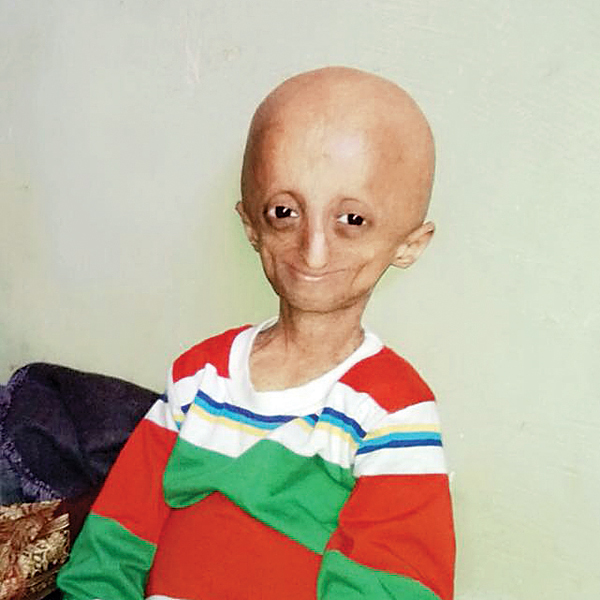 Mumbai boy avails the only known treatment for progeria in ... - 600 x 600 jpeg 212kB