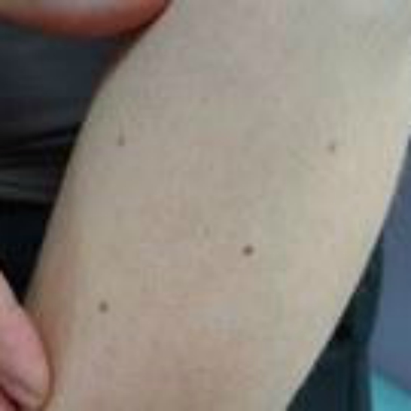 Moles on arm can predict skin cancer risk: New study - 600 x 600 jpeg 69kB