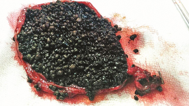 Nashik: 2,245 stones removed from man's gall bladder ... - 640 x 360 jpeg 682kB