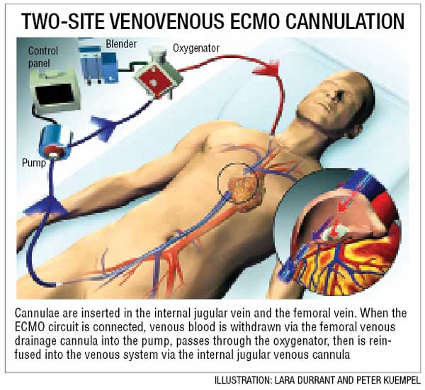 jaya-s-heart-and-lung-assisting-device-ecmo-explained