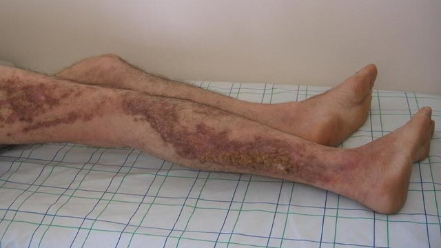 Kanpur girl gets rare incurable Darier's skin disease | Latest News & Updates at Daily News & Analysis