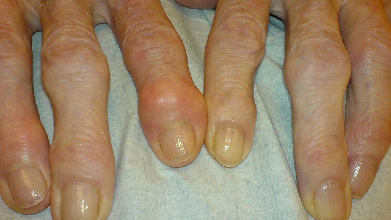 IIT scientists develop silk mats that could treat arthritis