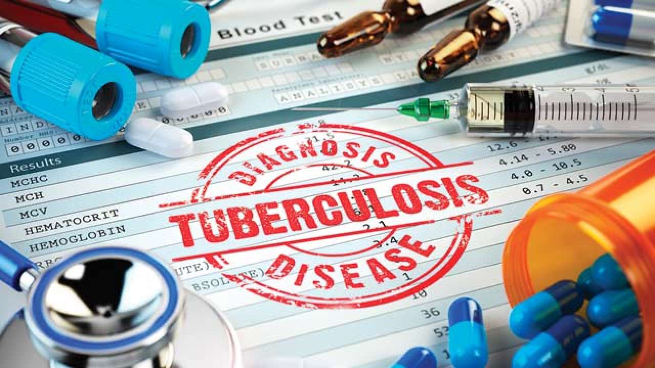 Notify government about TB cases or face prison, chemists warned